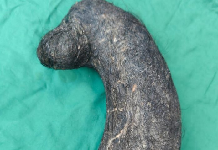 In Bareilly, a bunch of two kilos of hair came out from the stomach of a girl, even the doctor was surprised to see so much hair.